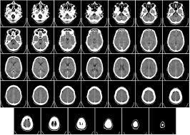 CT Scans pose threat